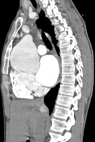File:Aortic coarctation with aneurysm (Radiopaedia 74818-85828 B 76).jpg