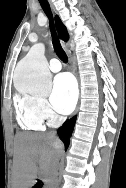 File:Aortic coarctation with aneurysm (Radiopaedia 74818-85828 B 78).jpg