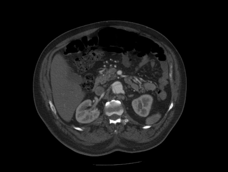 File:Aortic dissection (Radiopaedia 28802-29105 A 53).jpg