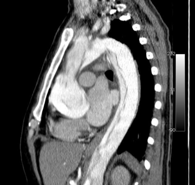 File:Aortic dissection - Stanford type A (Radiopaedia 29247-29659 C 24).jpg