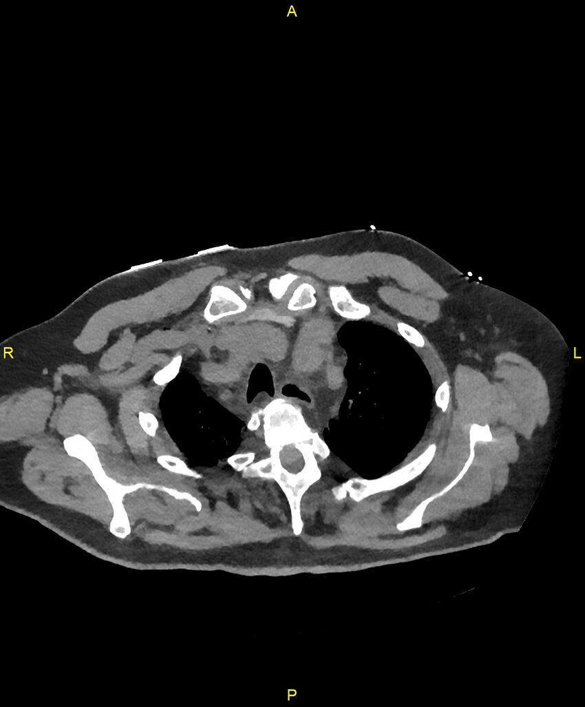 Aortic rupture (Radiopaedia 88822-105594 Axial non-contrast 29).jpg