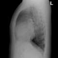 Aortic valve regurgitation (Radiopaedia 10685-11152 Lateral 1).png
