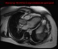 Aortic valve stenosis in a case of bicuspid aortic valve (Radiopaedia 17785).jpg