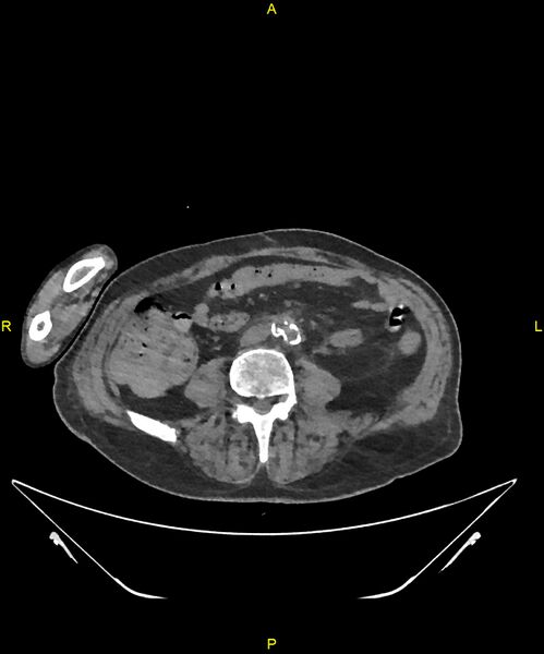 File:Aortoenteric fistula (Radiopaedia 84308-99603 Axial non-contrast 222).jpg