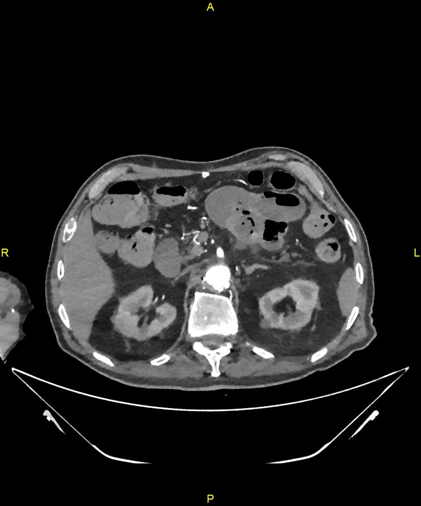 Aortoenteric fistula (Radiopaedia 84308-99603 B 96).jpg