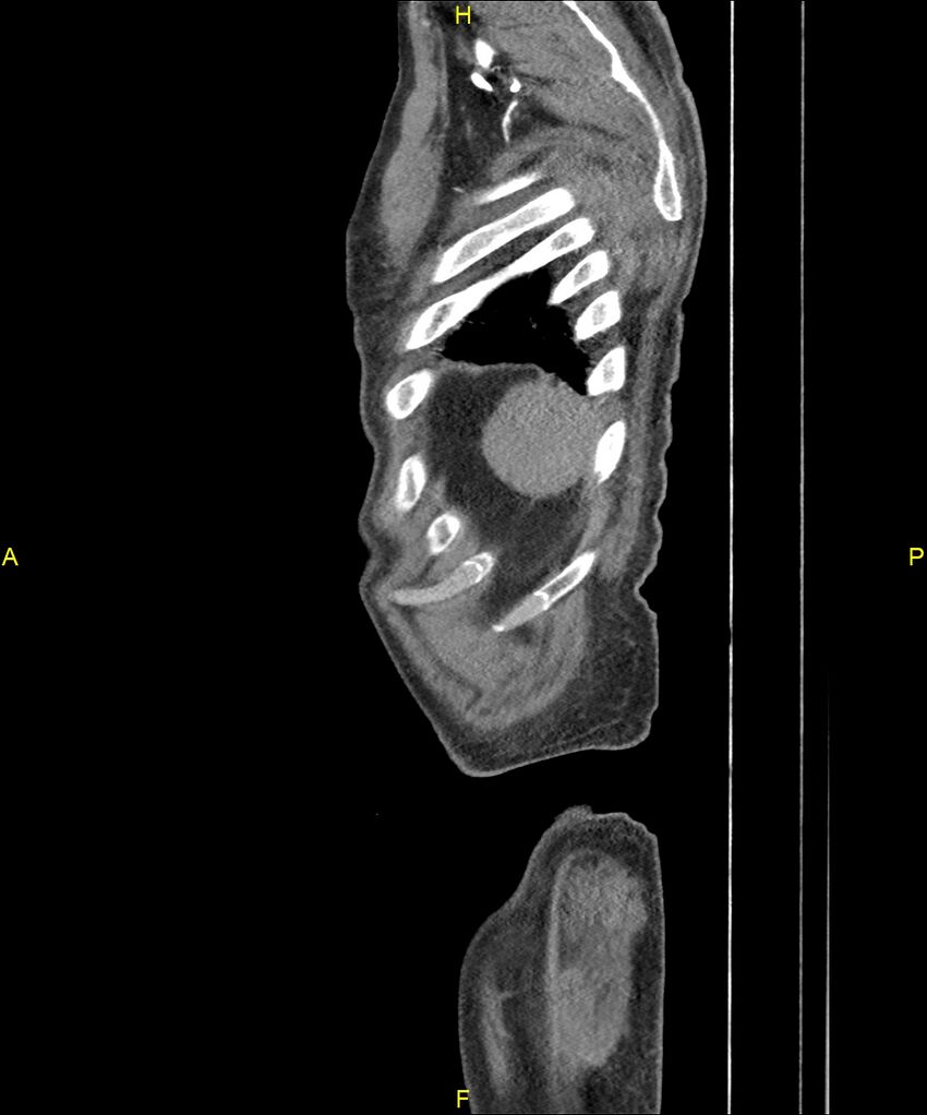 Aortoenteric fistula (Radiopaedia 84308-99603 C 318).jpg