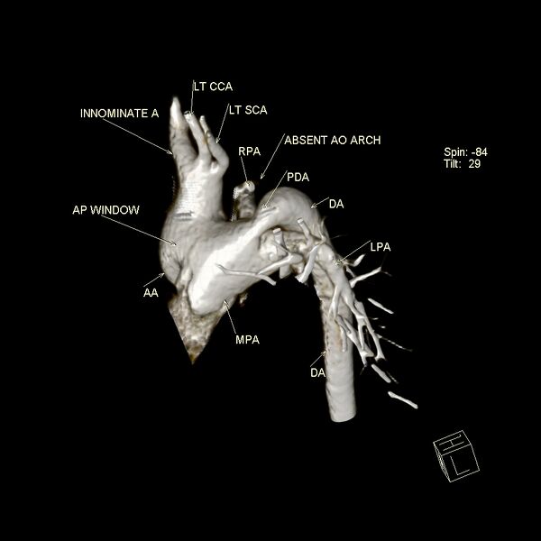 File:Aortopulmonary window, interrupted aortic arch and large PDA giving the descending aorta (Radiopaedia 35573-37077 3D 6).jpg
