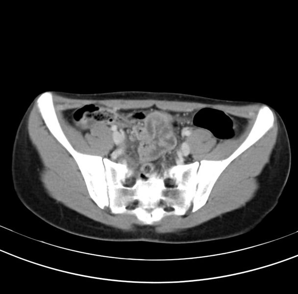 File:Appendicitis and incidental bicornuate uterus (Radiopaedia 22833-22853 B 35).jpg
