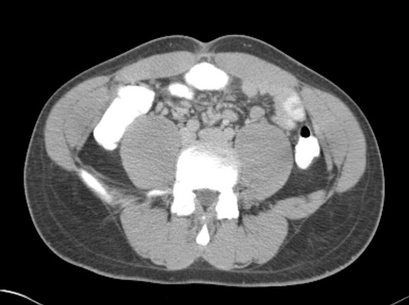 File:Appendicitis and incidental foregut duplication cyst (Radiopaedia 52962-58916 A 53).jpg