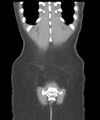 Appendicitis with minimal stranding but appendicolith (Radiopaedia 29035-29397 B 39).jpg