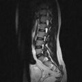 Arachnoid cyst - spinal (Radiopaedia 66835-76157 Sagittal T2 3).jpg
