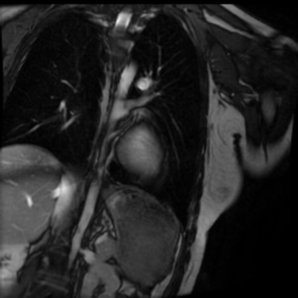 File:Arrhythmogenic right ventricular cardiomyopathy (Radiopaedia 87505-103850 2ch (LV) Cine SSFP 75).jpg