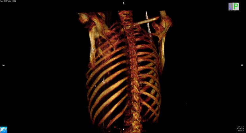 File:Arrow injury to the neck (Radiopaedia 75225-86323 3D bone 18).jpg