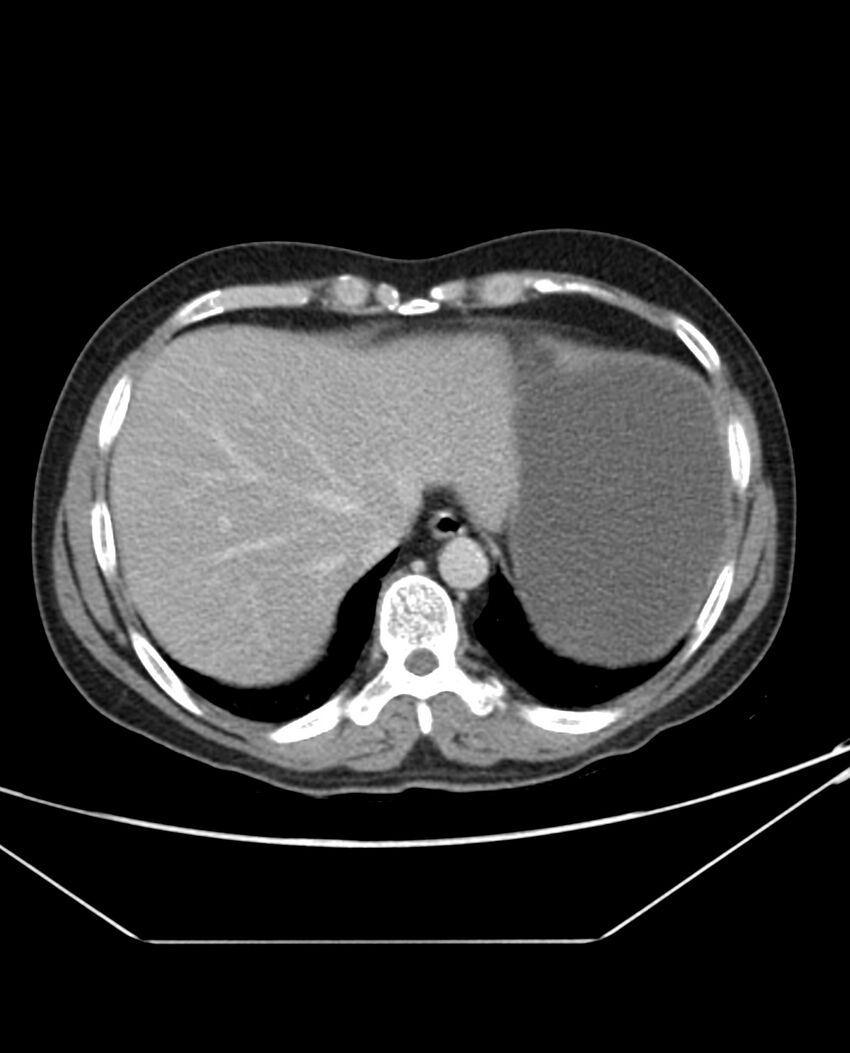 Arterial occlusive mesenteric ischemia (Radiopaedia 84641-100054 A 13).jpg