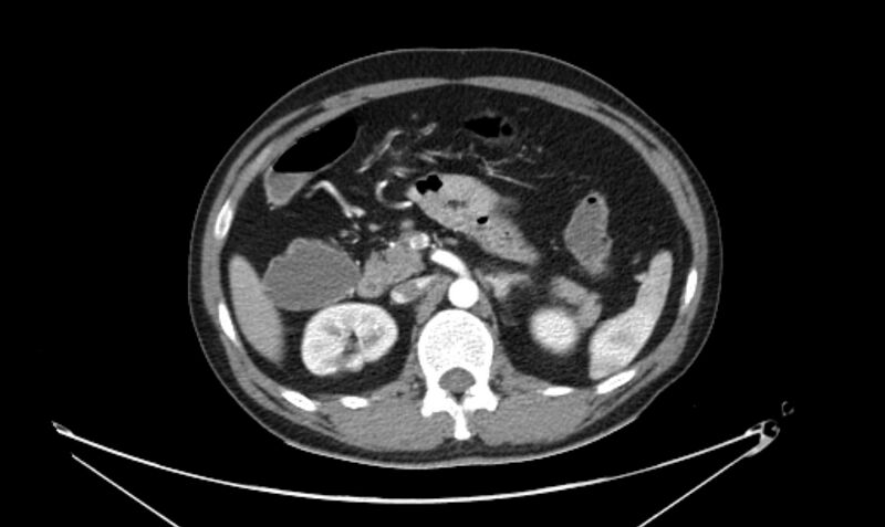 File:Arterial occlusive mesenteric ischemia (Radiopaedia 84641-100060 A 51).jpg