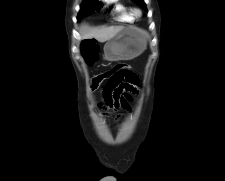 File:Arterial occlusive mesenteric ischemia (Radiopaedia 84641-100060 B 7).jpg