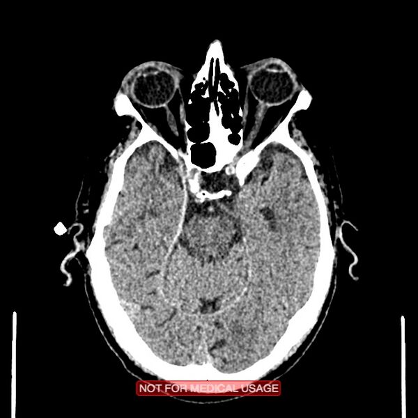 File:Artery of Percheron infarction (Radiopaedia 28679-28967 Axial non-contrast 42).jpg