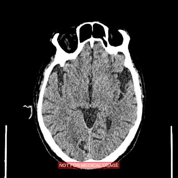 File:Artery of Percheron infarction (Radiopaedia 28679-28967 Axial non-contrast 55).jpg