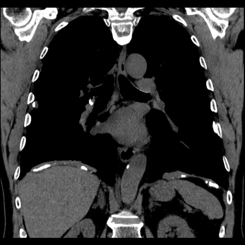 Asbestos-related pleural plaques (Radiopaedia 39069-41255 Coronal non-contrast 36).jpg