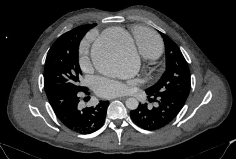 File:Ascending aortic aneurysm (Radiopaedia 86279-102297 C 32).jpg