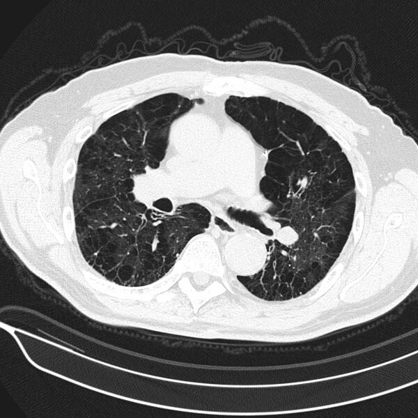 File:Aspergilloma (Radiopaedia 24521-24804 Axial lung window 9).jpg