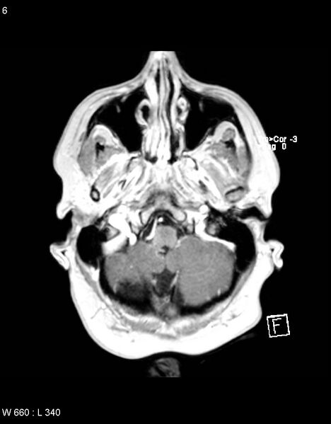 File:Astroblastoma (Radiopaedia 39792-42218 Axial T1 C+ 5).jpg