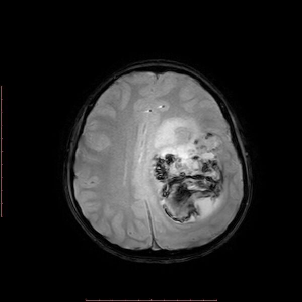 File:Astroblastoma (Radiopaedia 74287-85162 Axial SWI 15).jpg