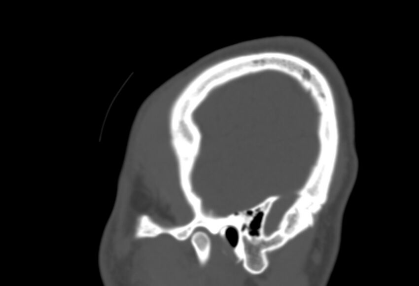 Asymptomatic occipital spur (Radiopaedia 87753-104201 Sagittal bone window 286).jpg