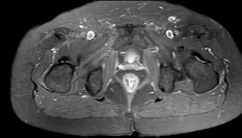 Atypical lipomatous tumor - thigh (Radiopaedia 68975-78734 Axial PD fat sat 88).jpg