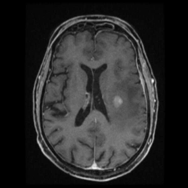 File:Atypical meningioma (Radiopaedia 45535-49629 Axial T1 C+ 42).jpg