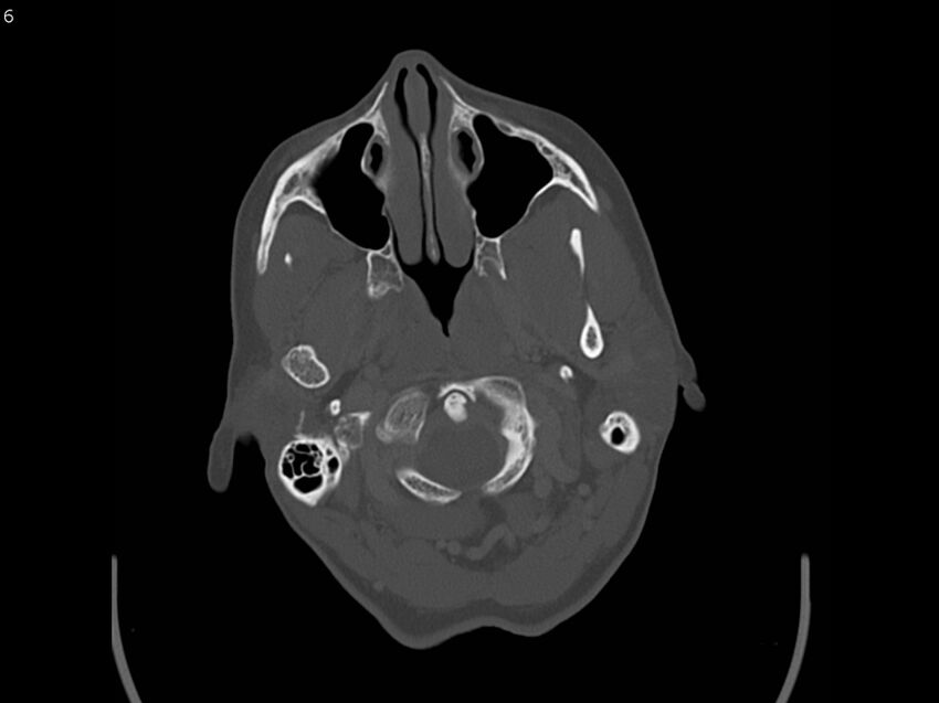Atypical meningioma - intraosseous (Radiopaedia 64915-73867 Axial C+ bone window 6).jpg