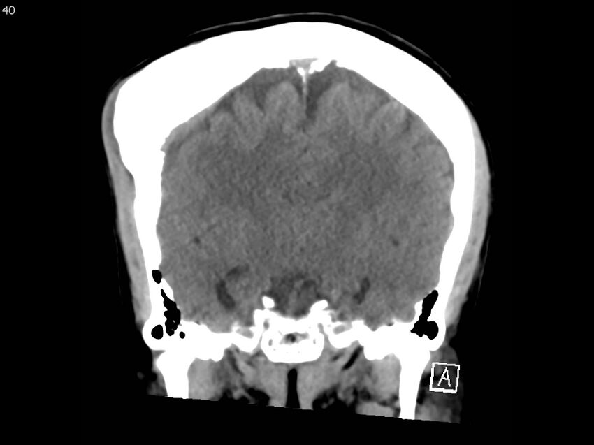 Atypical meningioma - intraosseous (Radiopaedia 64915-73867 B 39).jpg
