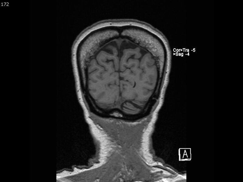 File:Atypical meningioma - intraosseous (Radiopaedia 64915-74572 Coronal T1 172).jpg