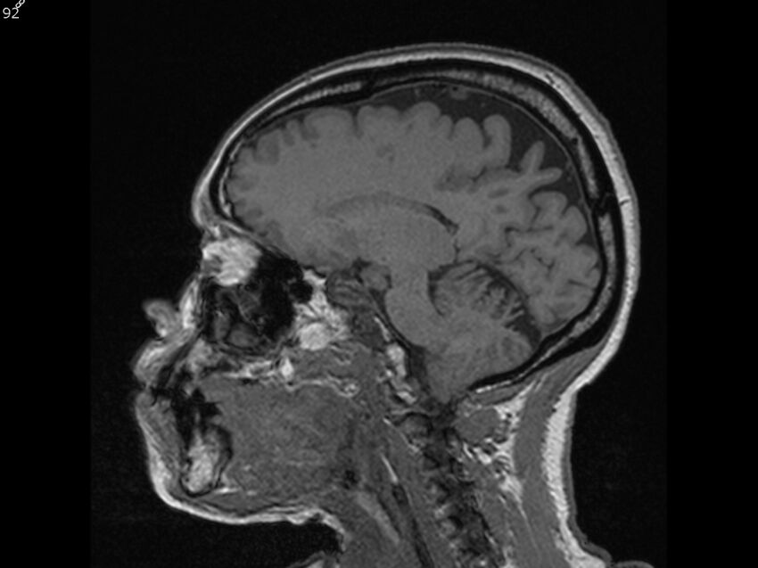 Atypical meningioma - intraosseous (Radiopaedia 64915-74572 Sagittal T1 92).jpg