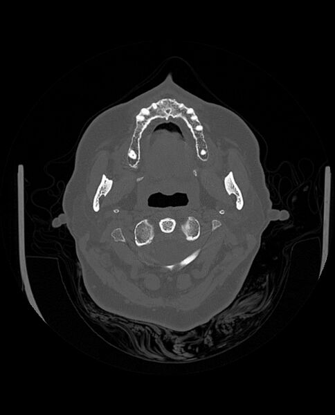 File:Automastoidectomy with labyrinthine fistula (Radiopaedia 84143-99411 Axial non-contrast 30).jpg
