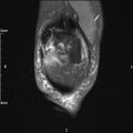 Avulsion fracture of the fibular head (Radiopaedia 74804-85808 Coronal PD fat sat 8).jpg