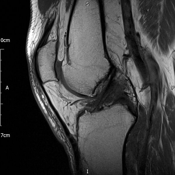 File:Avulsion fracture of the fibular head (Radiopaedia 74804-85808 D 18).jpg