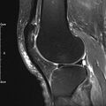 Avulsion fracture of the fibular head (Radiopaedia 74804-85808 Sagittal PD fat sat 23).jpg
