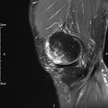 Avulsion fracture of the fibular head (Radiopaedia 74804-85808 Sagittal PD fat sat 7).jpg