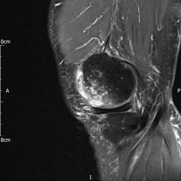 File:Avulsion fracture of the fibular head (Radiopaedia 74804-85808 Sagittal PD fat sat 7).jpg