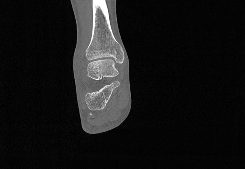 File:Avulsion fractures of talus and calcaneus (Radiopaedia 48277-53155 Coronal bone window 60).jpg
