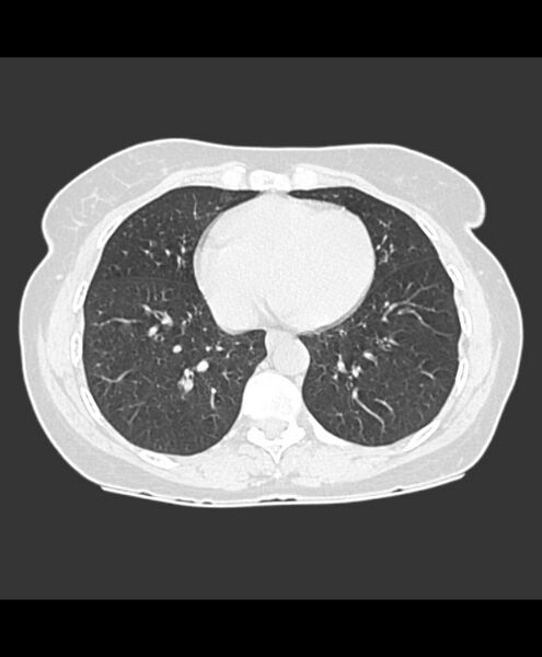 File:Azygos fissure and azygos lobe (Radiopaedia 41841-44832 Axial lung window 6).jpg
