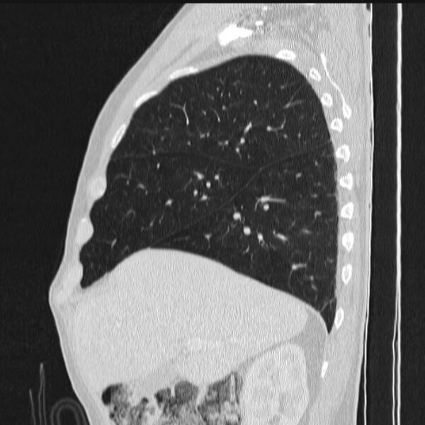 File:Azygos lobe (Radiopaedia 38259-40275 lung window 28).jpg