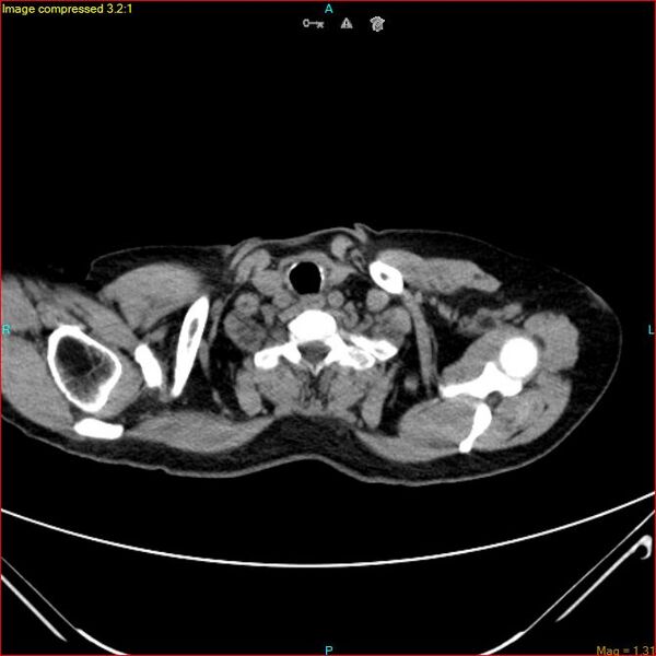 File:Azygos vein aneurysm (Radiopaedia 77824-90130 A 4).jpg