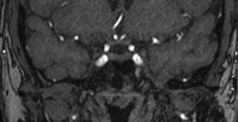File:Basilar artery fenestration (Radiopaedia 74537-85455 Coronal MRA TOF 3).jpg