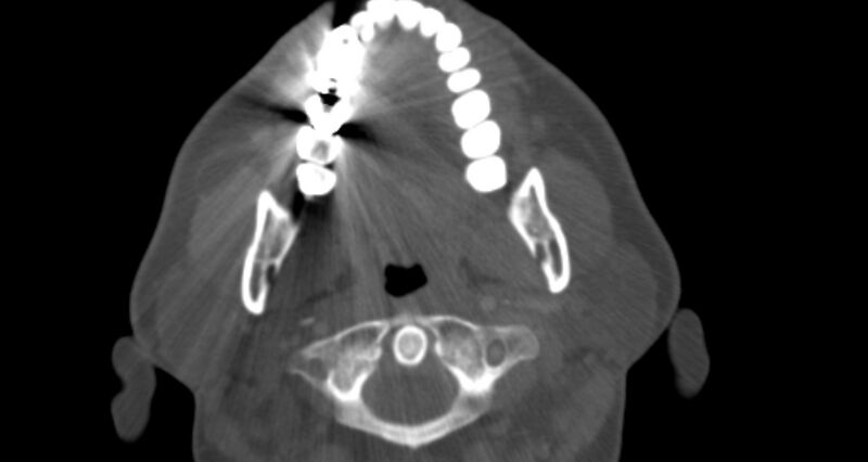 File:Benign mixed salivary tumor of the parotid gland (Radiopaedia 35261-36792 Axial bone window 17).jpg