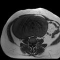 Benign seromucinous cystadenoma of the ovary (Radiopaedia 71065-81300 Axial T1 21).jpg