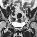 Bicornuate uterus (Radiopaedia 11104-11492 Coronal T2 4).jpg