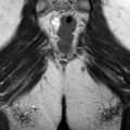 Bicornuate uterus (Radiopaedia 61974-70046 Coronal T2 30).jpg