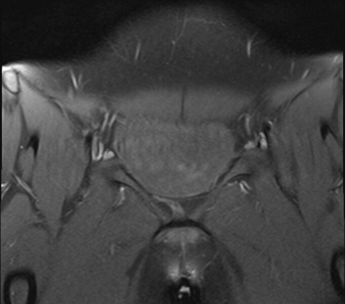 File:Bicornuate uterus (Radiopaedia 71214-81511 Coronal T1 fat sat 29).jpg